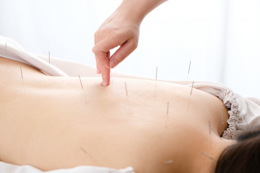 Acupuncture Paris : où trouver un bon praticien ?